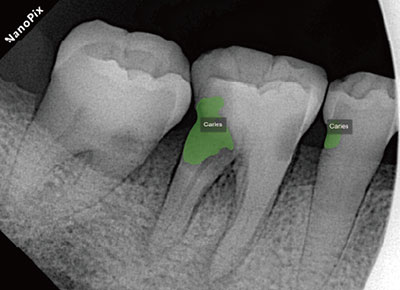 Caries