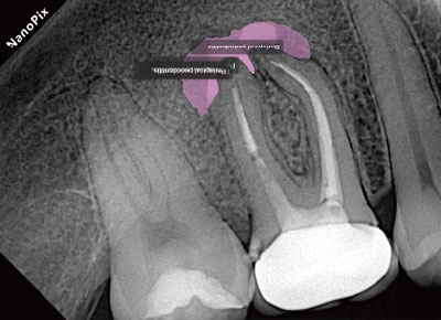 Periapical Periodontitis