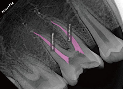 Root Canal Therapy