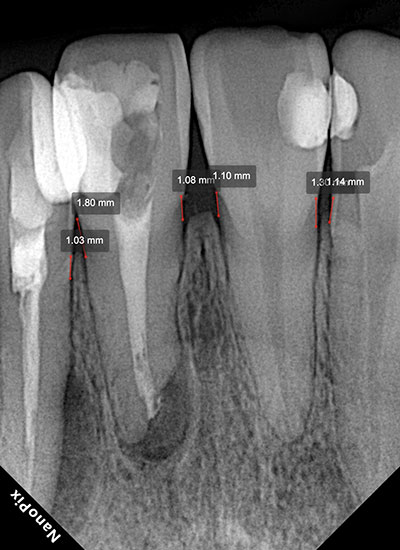 Bone Level