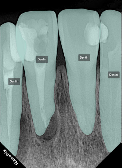 Dentin